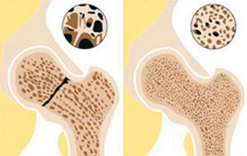 Osteoporose Prävention auf dem Trampolin