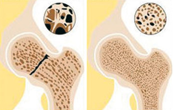 Osteoporose Prävention auf dem Trampolin Osteoporose Prävention auf dem Trampolin
